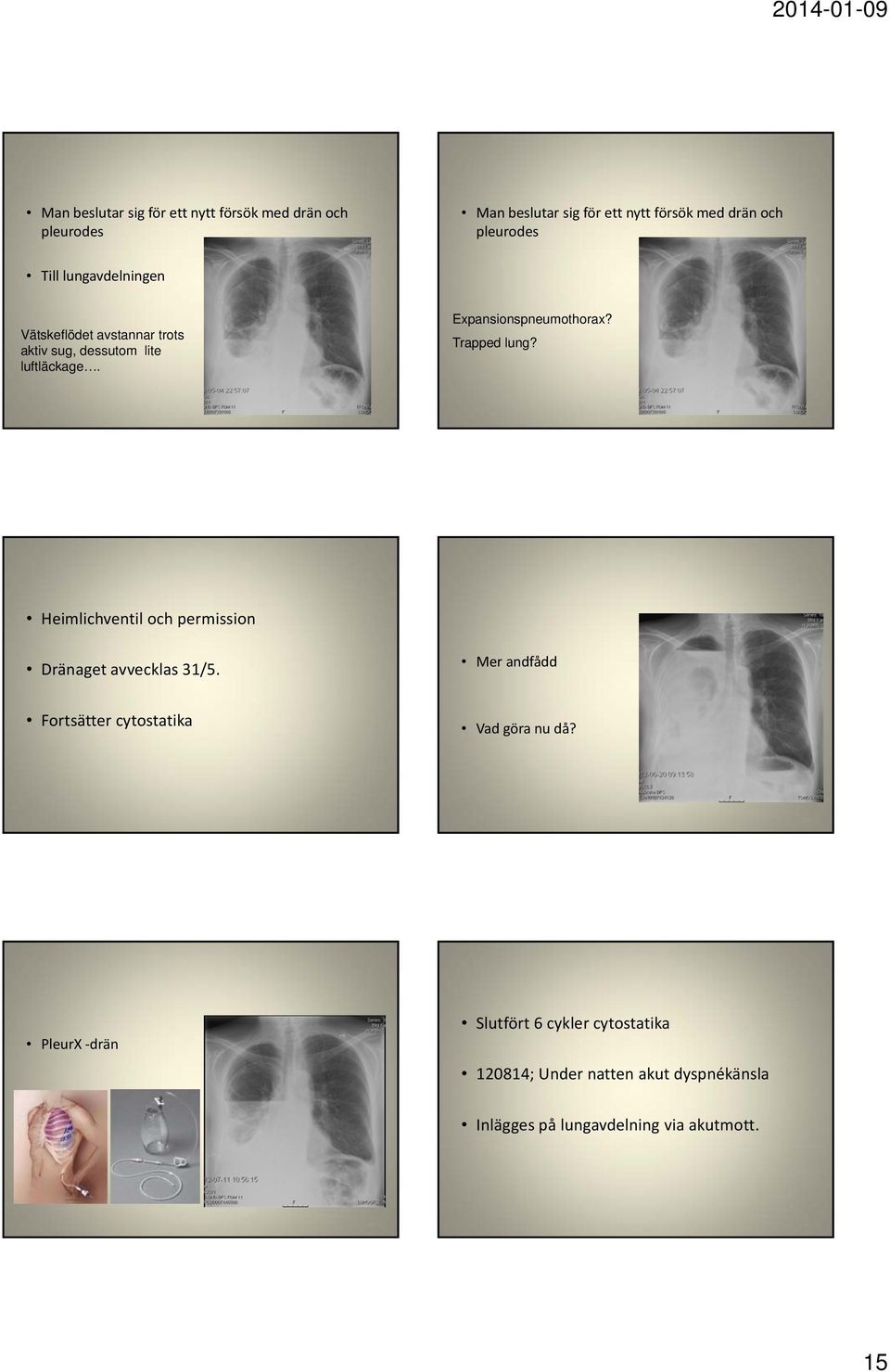 Trapped lung? 85 86 Heimlichventil och permission Dränaget avvecklas 31/5.