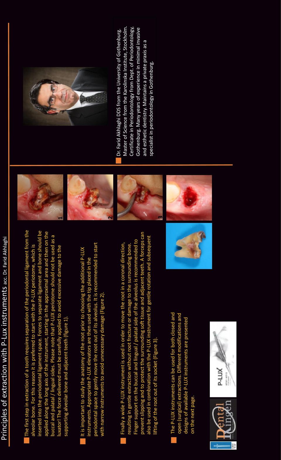 For this reason it is preferred to start with the P-LUX periotome, which is inserted into the periodontal ligament space.