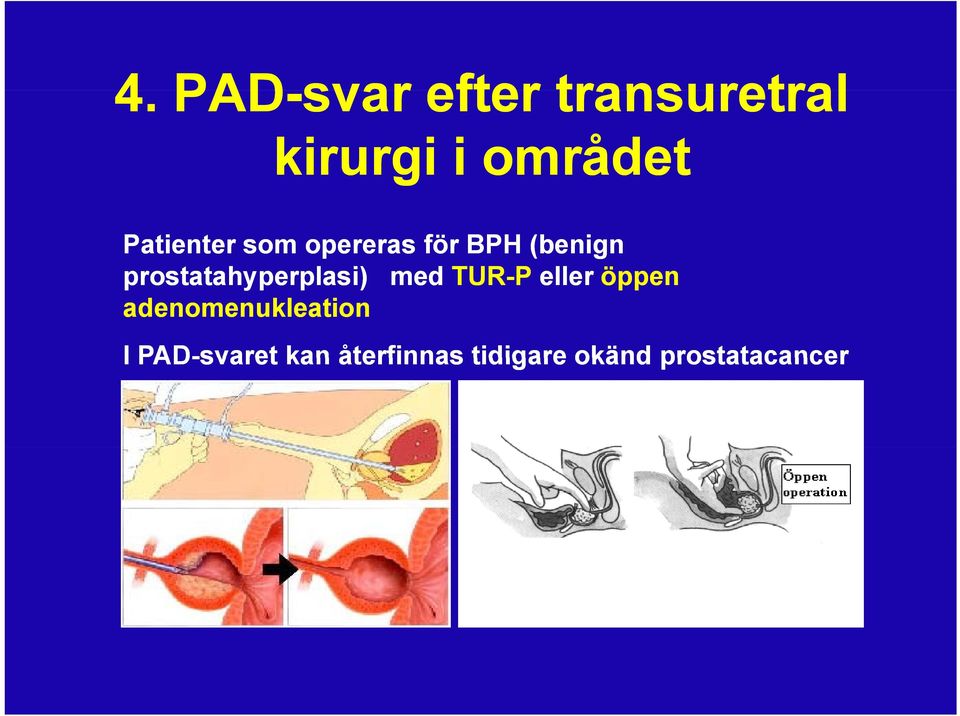 prostatahyperplasi) t med TUR-P eller öppen