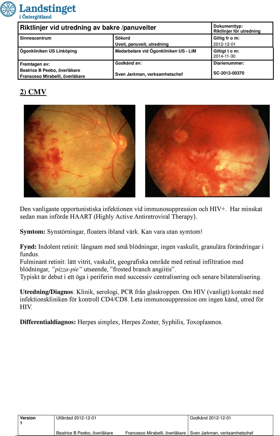 Fulminant retinit: lätt vitrit, vaskulit, geografiska område med retinal infiltration med blödningar, pizza-pie utseende, frosted branch angiitis.