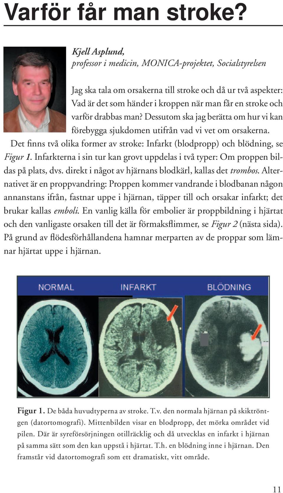 drabbas man? Dessutom ska jag berätta om hur vi kan förebygga sjukdomen utifrån vad vi vet om orsakerna. Det finns två olika former av stroke: Infarkt (blodpropp) och blödning, se Figur 1.