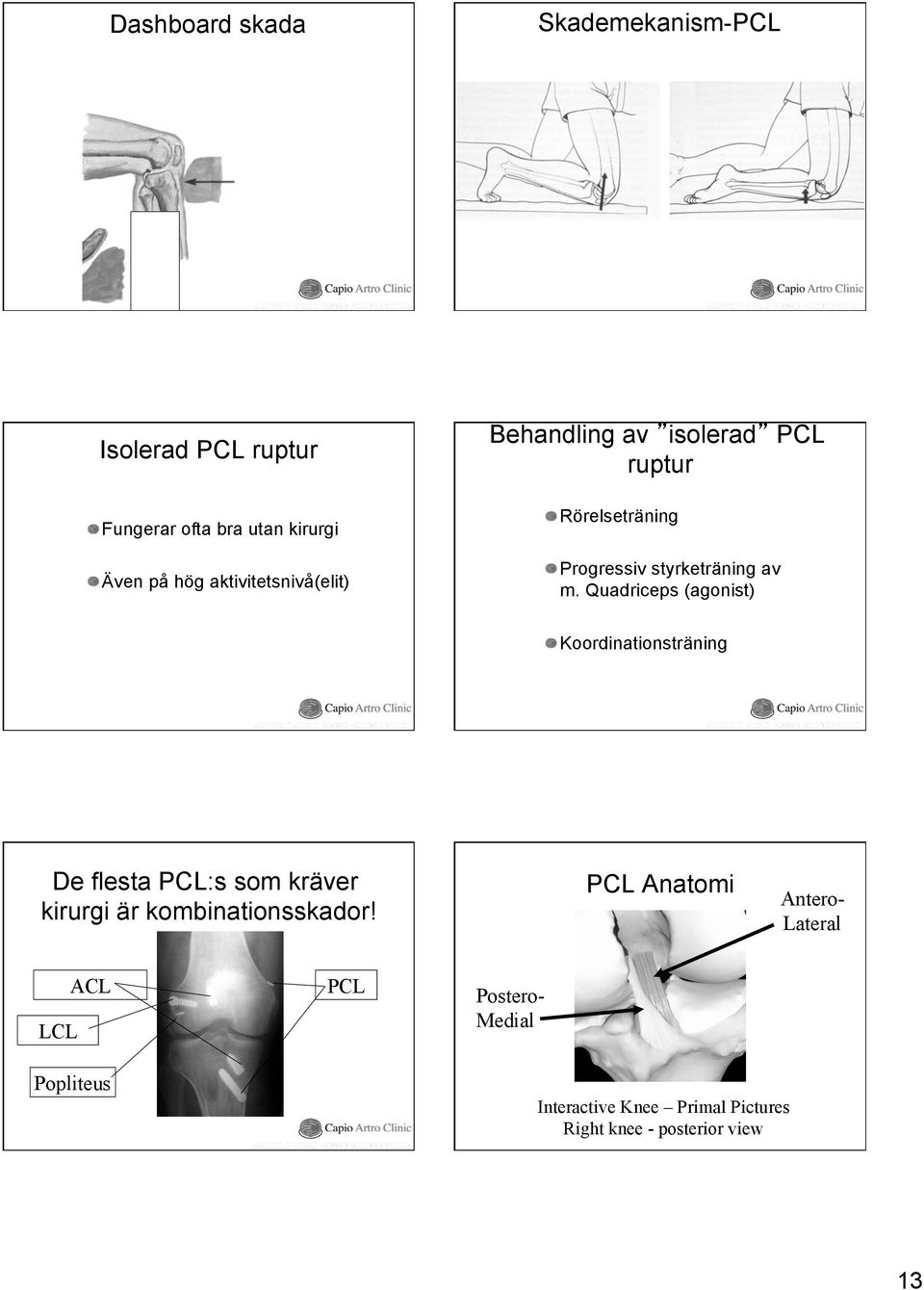 Quadriceps (agonist) Koordinationsträning De flesta PCL:s som kräver kirurgi är kombinationsskador PCL