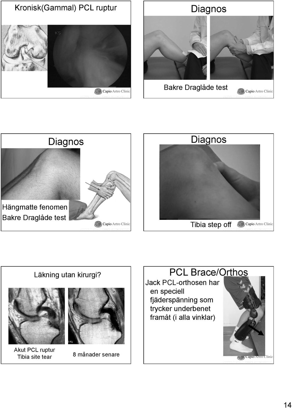 PCL Brace/Orthos Jack PCL-orthosen har en speciell fjäderspänning som trycker