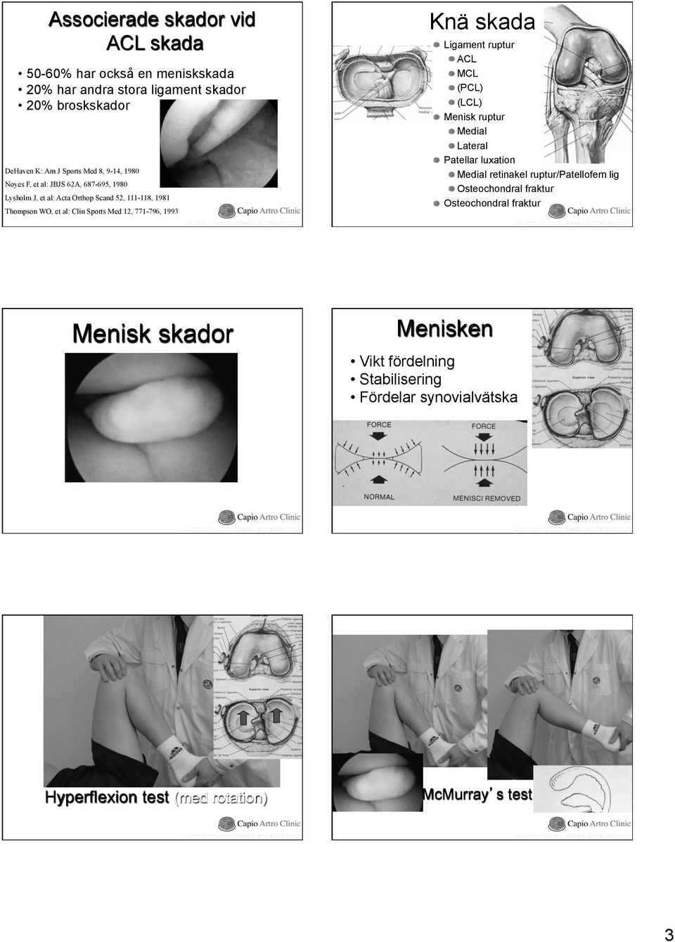 Menisk skador Knä skada Ligament ruptur ACL MCL (PCL) (LCL) Menisk ruptur Medial Lateral Patellar luxation Medial retinakel ruptur/patellofem lig