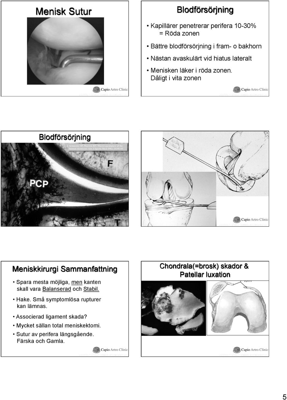Dåligt i vita zonen Blodförsörjning Arnoczky SP, Warren RF: Microvasculature of the human meniscus: Am J Sports Med 1982; 10:90-95 Meniskkirurgi