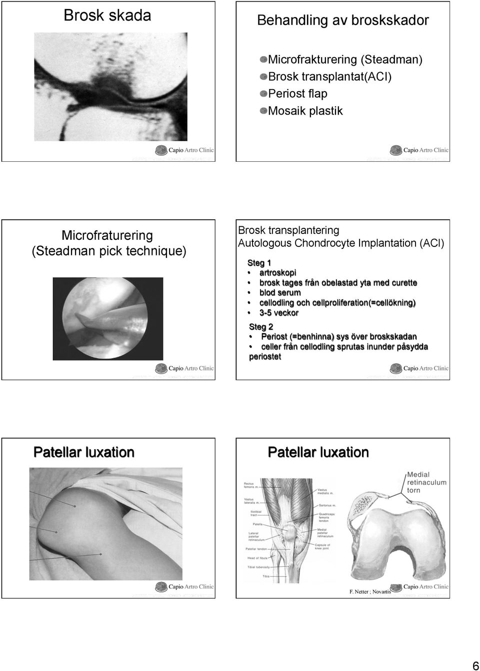 brosk tages från obelastad yta med curette blod serum cellodling och cellproliferation(=cellökning) 3-5 veckor Steg 2 Periost