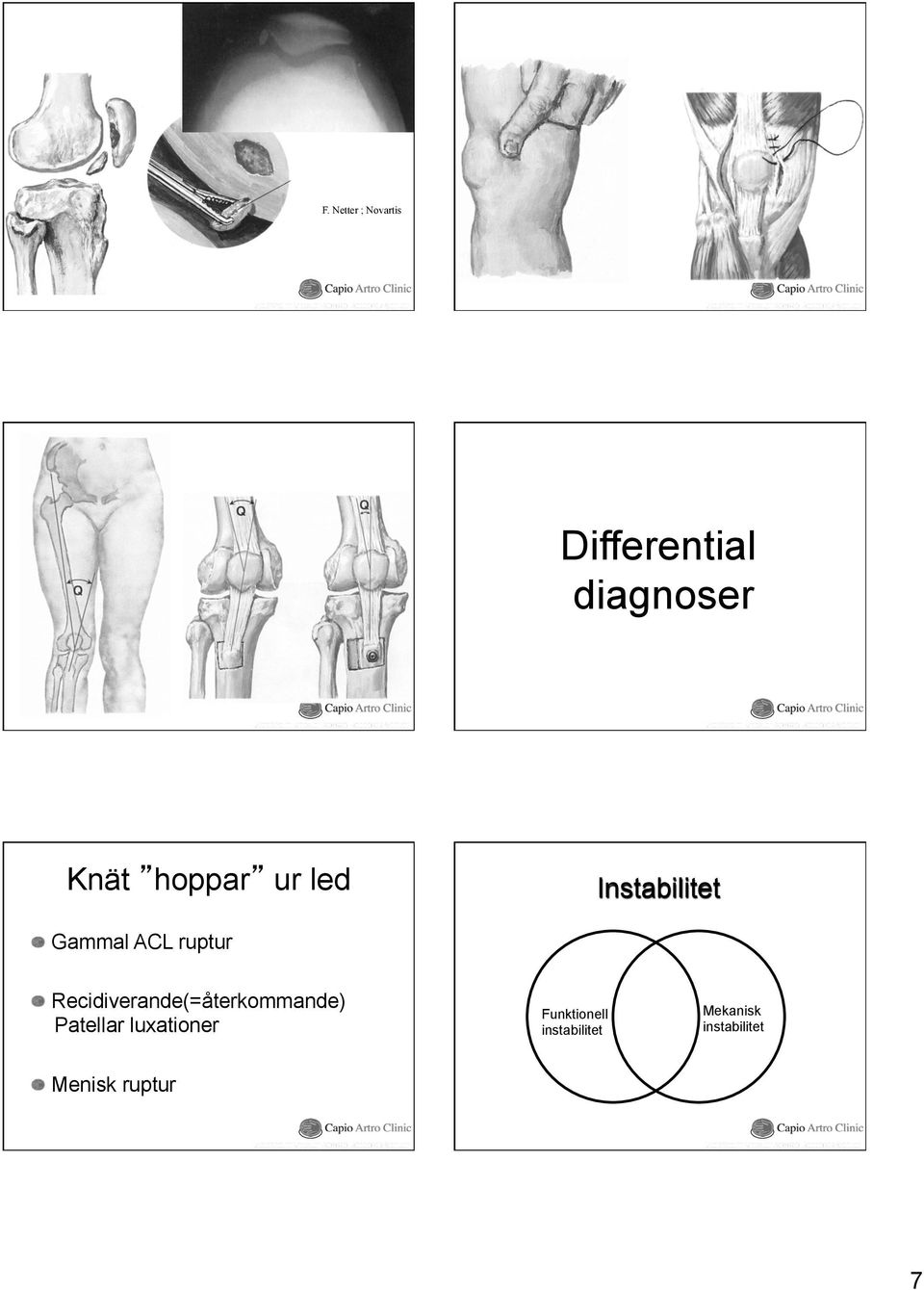 Recidiverande(=återkommande) Patellar luxationer