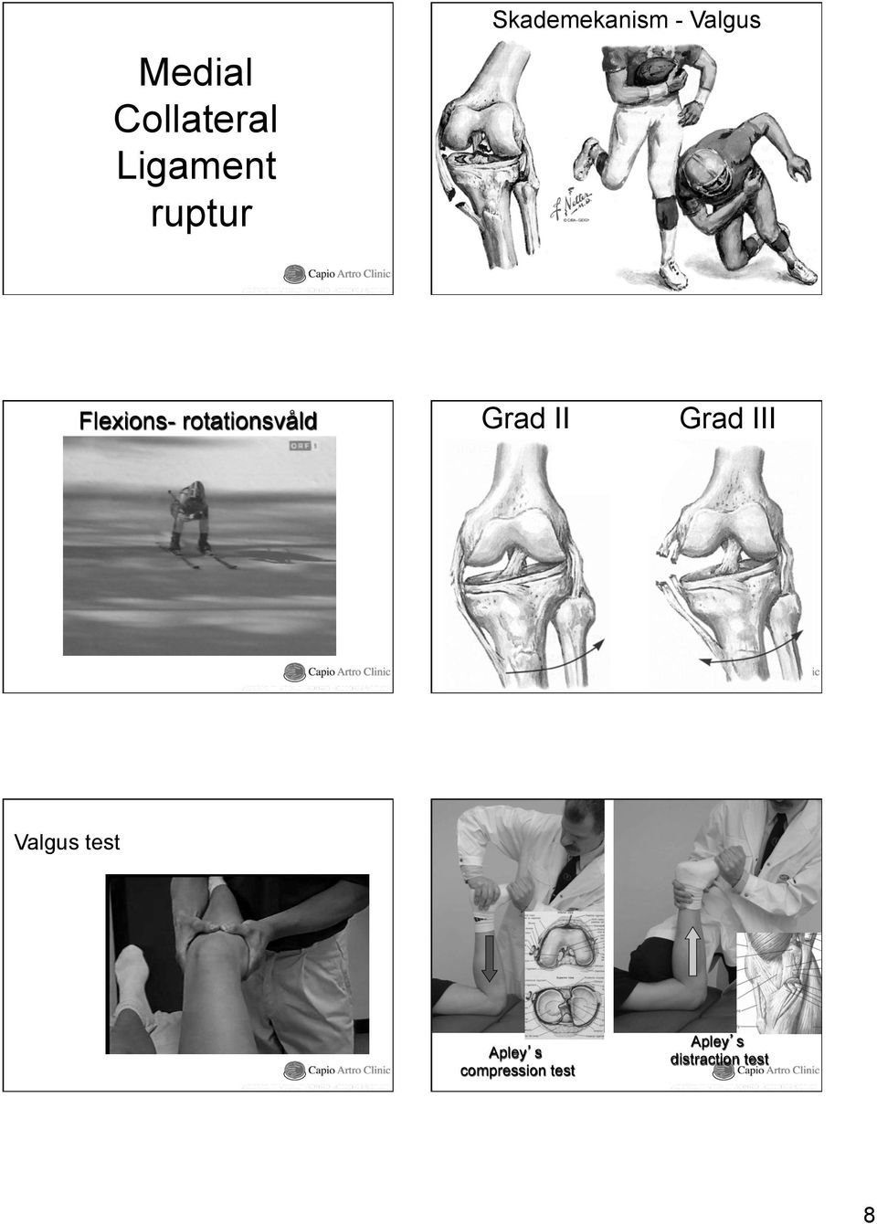 rotationsvåld Grad II Grad III Valgus