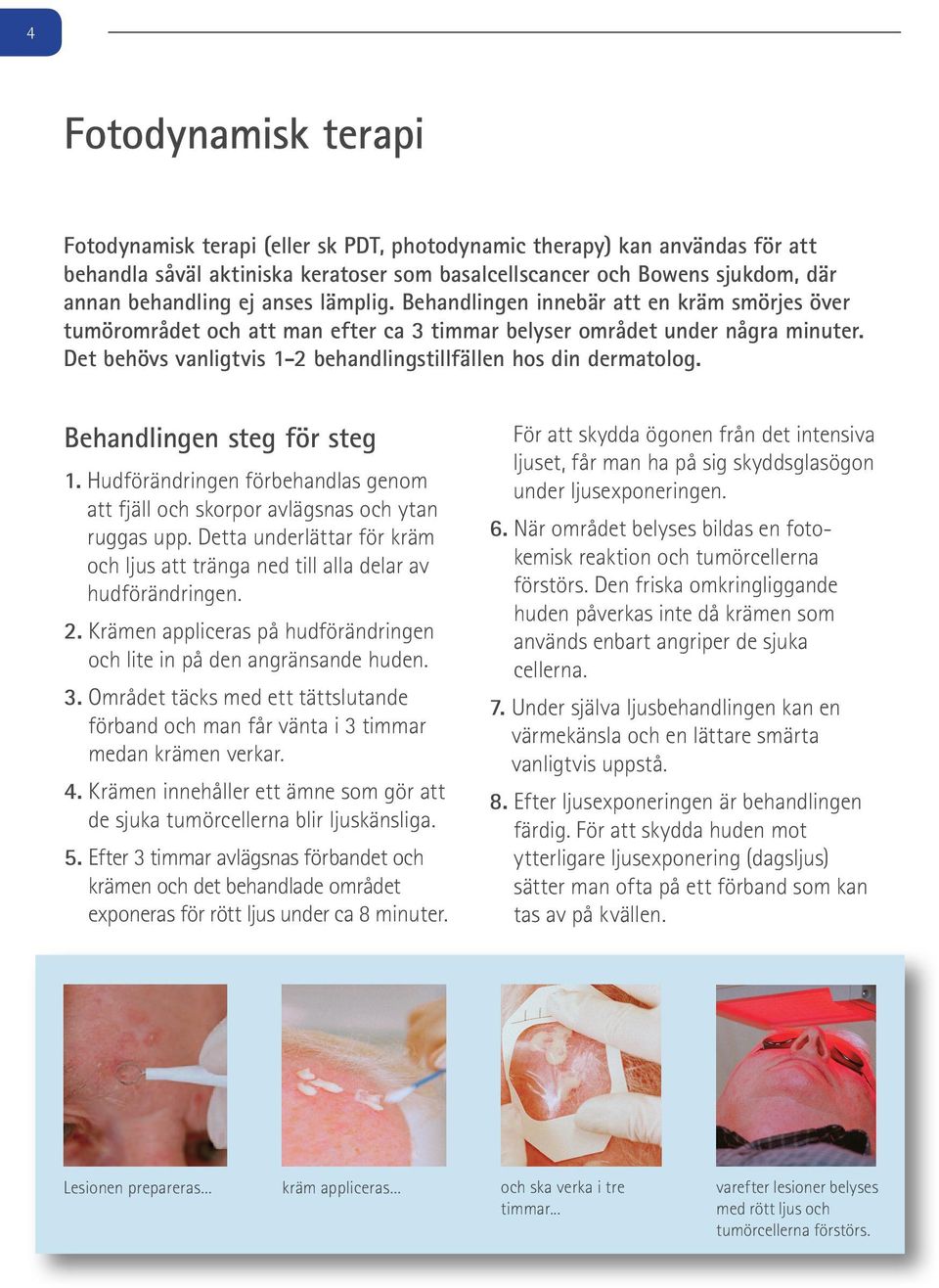 Det behövs vanligtvis 1-2 behandlingstillfällen hos din dermatolog. Behandlingen steg för steg 1. Hudförändringen förbehandlas genom att fjäll och skorpor avlägsnas och ytan ruggas upp.