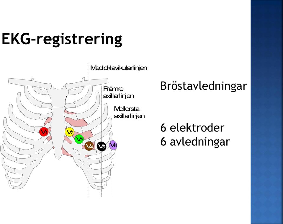 axillarlinjen Bröstavledningar V1 V2