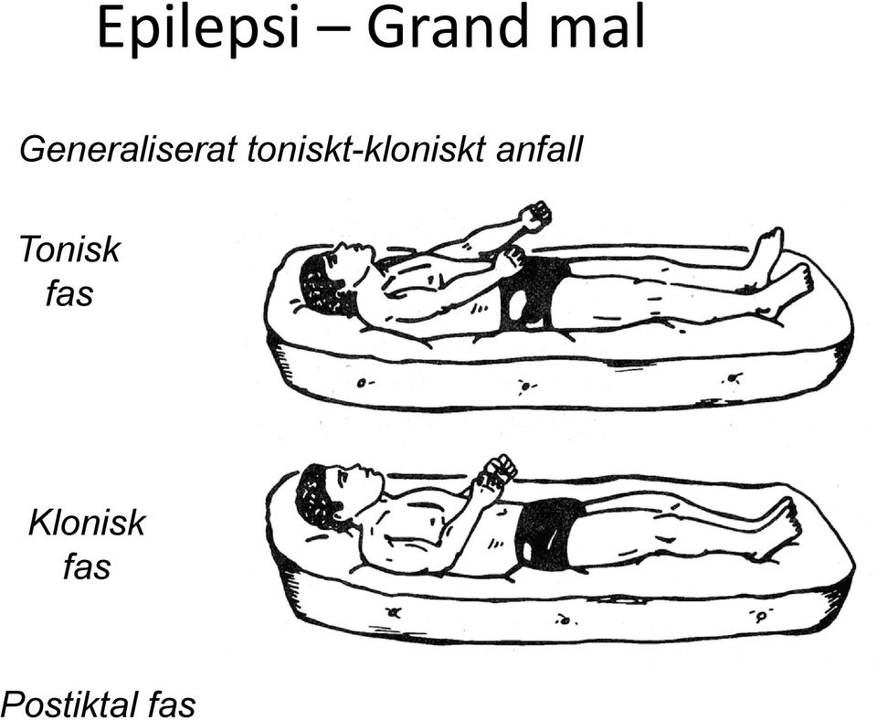 toniskt-kloniskt anfall