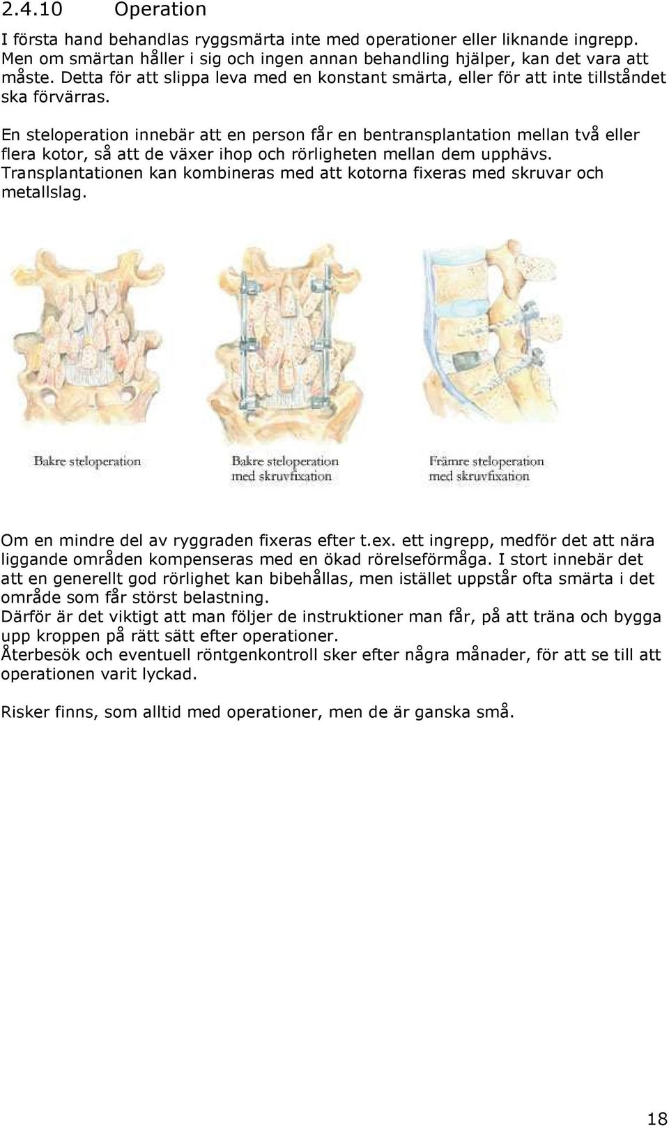 En steloperation innebär att en person får en bentransplantation mellan två eller flera kotor, så att de växer ihop och rörligheten mellan dem upphävs.