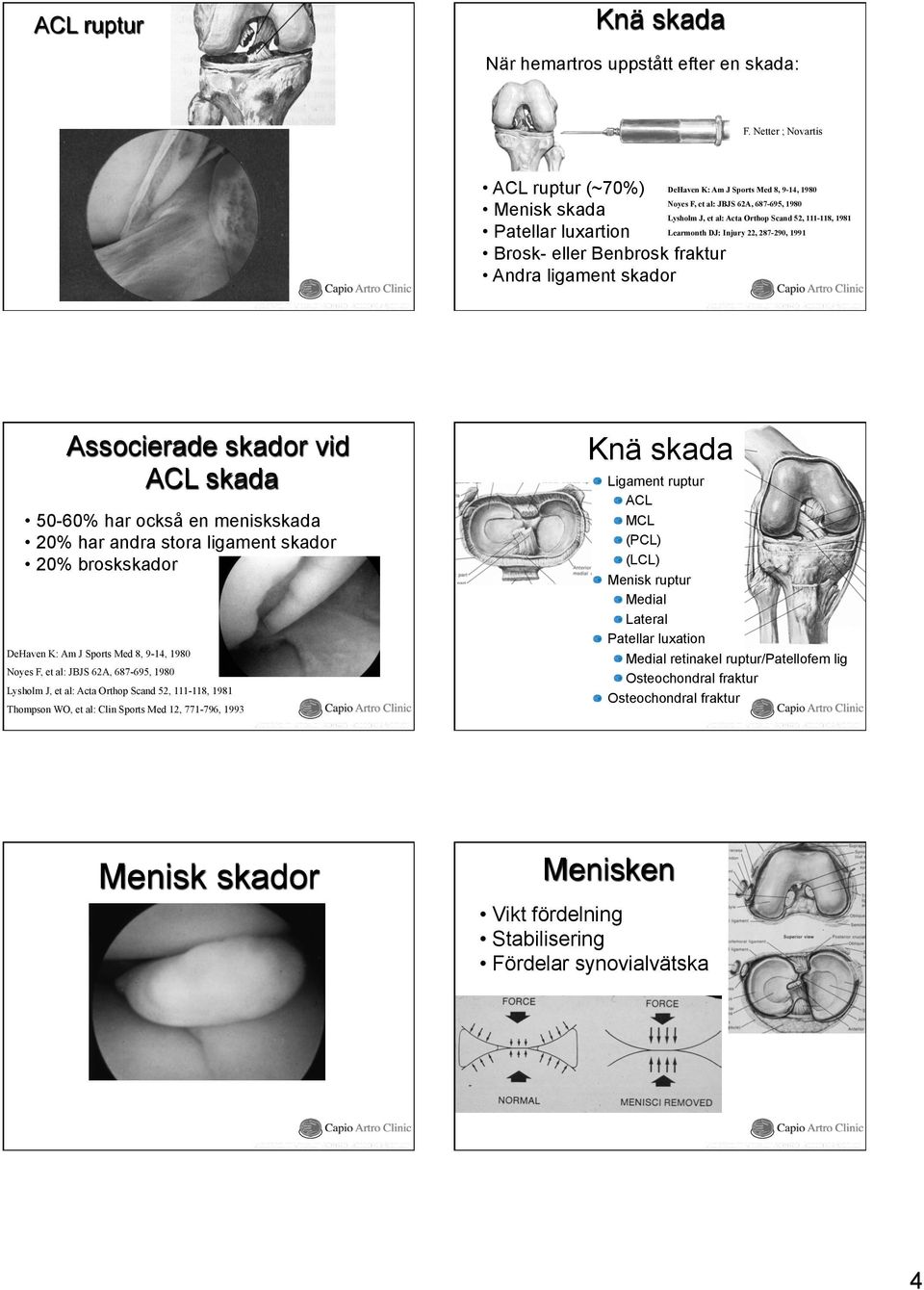 1980 Lysholm J, et al: Acta Orthop Scand 52, 111-118, 1981 Learmonth DJ: Injury 22, 287-290, 1991 Associerade skador vid ACL skada 50-60% har också en meniskskada 20% har andra stora ligament skador