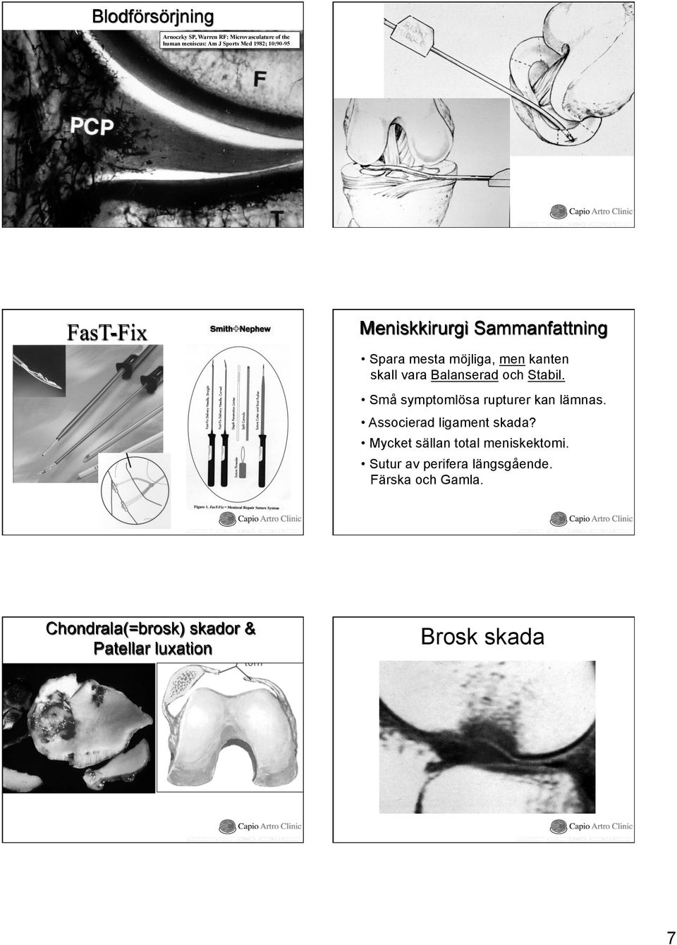 Stabil. Små symptomlösa rupturer kan lämnas. Associerad ligament skada? Mycket sällan total meniskektomi.