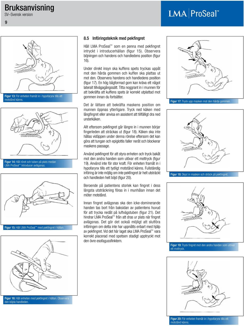 Observera böjningen och handens och handledens position (figur 16). Under direkt insyn ska kuffens spets tryckas uppåt mot den hårda gommen och kuffen ska plattas ut mot den.