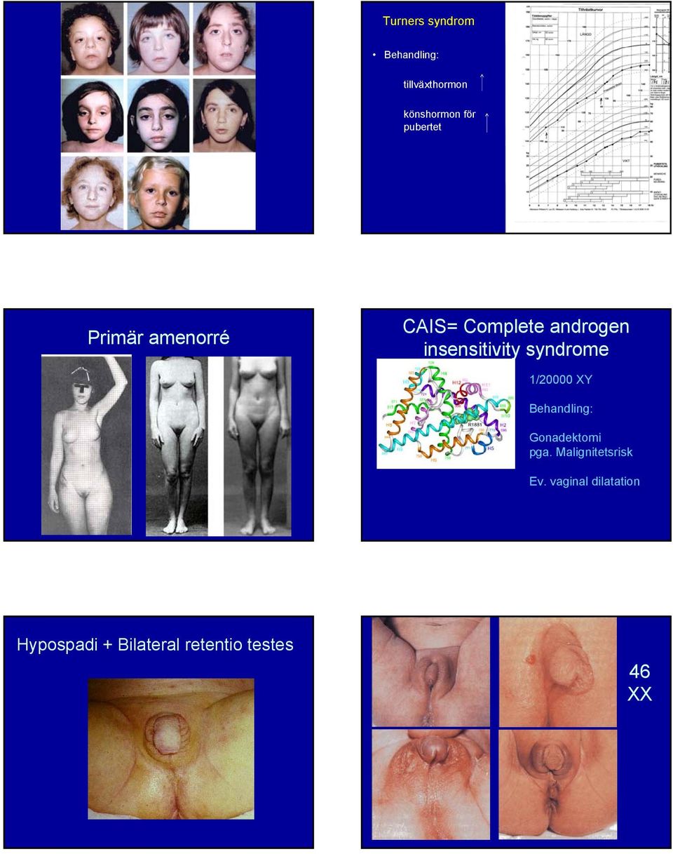 syndrome 1/20000 XY Behandling: Gonadektomi pga.