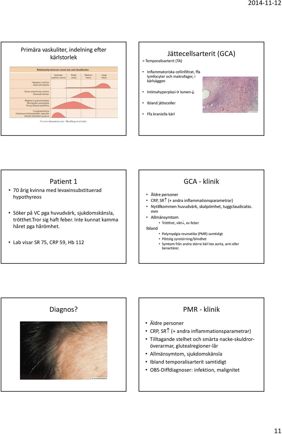Inte kunnat kamma håret pga hårömhet. Lab visar SR 75, CRP 59, Hb 112 GCA klinik Äldre personer CRP, SR (+ andra inflammationsparametrar) Nytillkommen huvudvärk, skalpömhet, tuggclaudicatio.