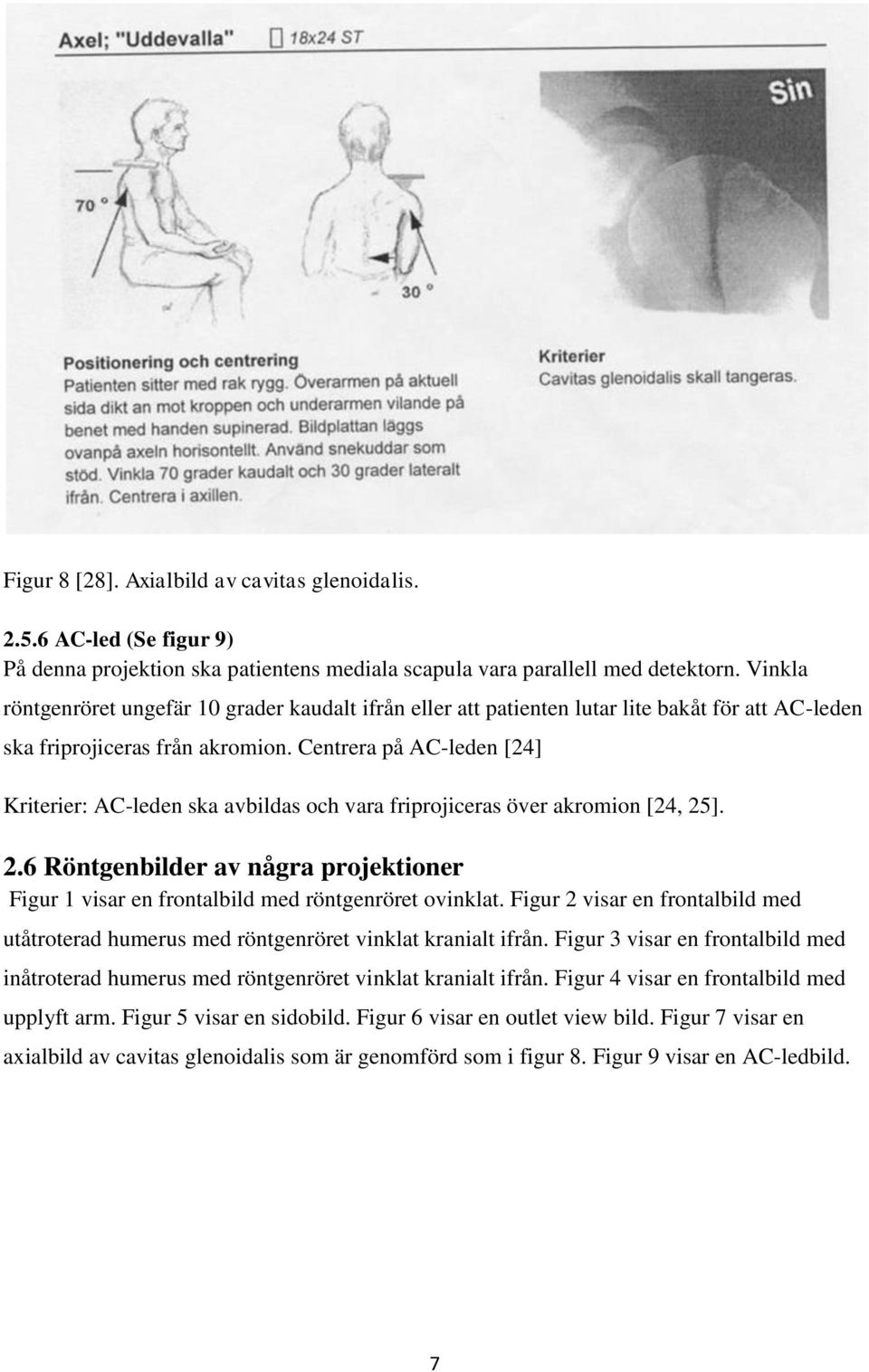 Centrera på AC-leden [24] Kriterier: AC-leden ska avbildas och vara friprojiceras över akromion [24, 25]. 2.6 Röntgenbilder av några projektioner Figur 1 visar en frontalbild med röntgenröret ovinklat.