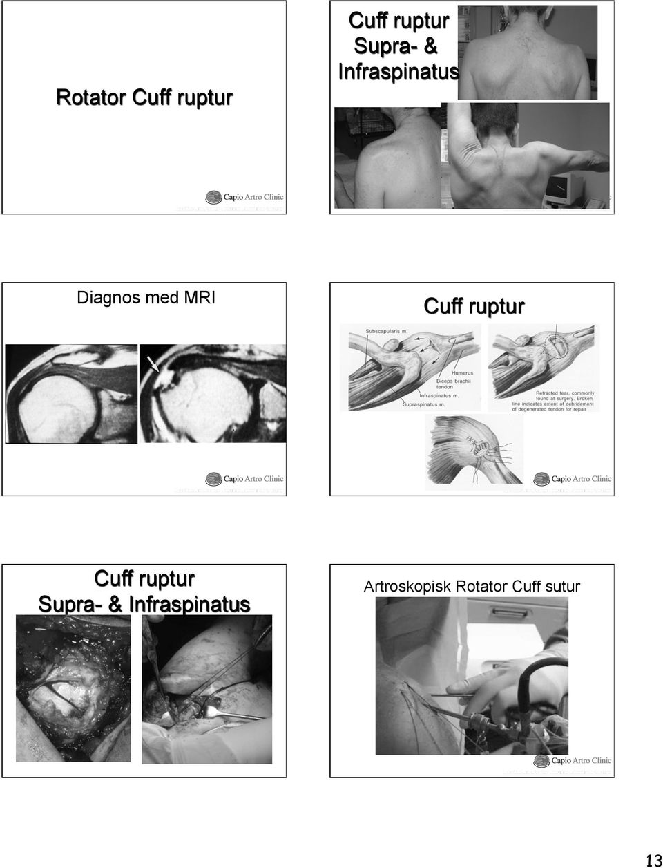 MRI Cuff ruptur Cuff ruptur Supra- &