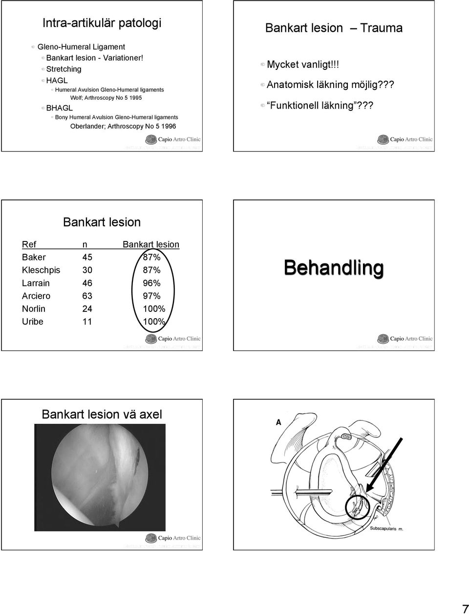 Bony Humeral Avulsion Gleno-Humeral ligaments Oberlander; Arthroscopy No 5 1996 Bankart lesion Trauma! Mycket vanligt!