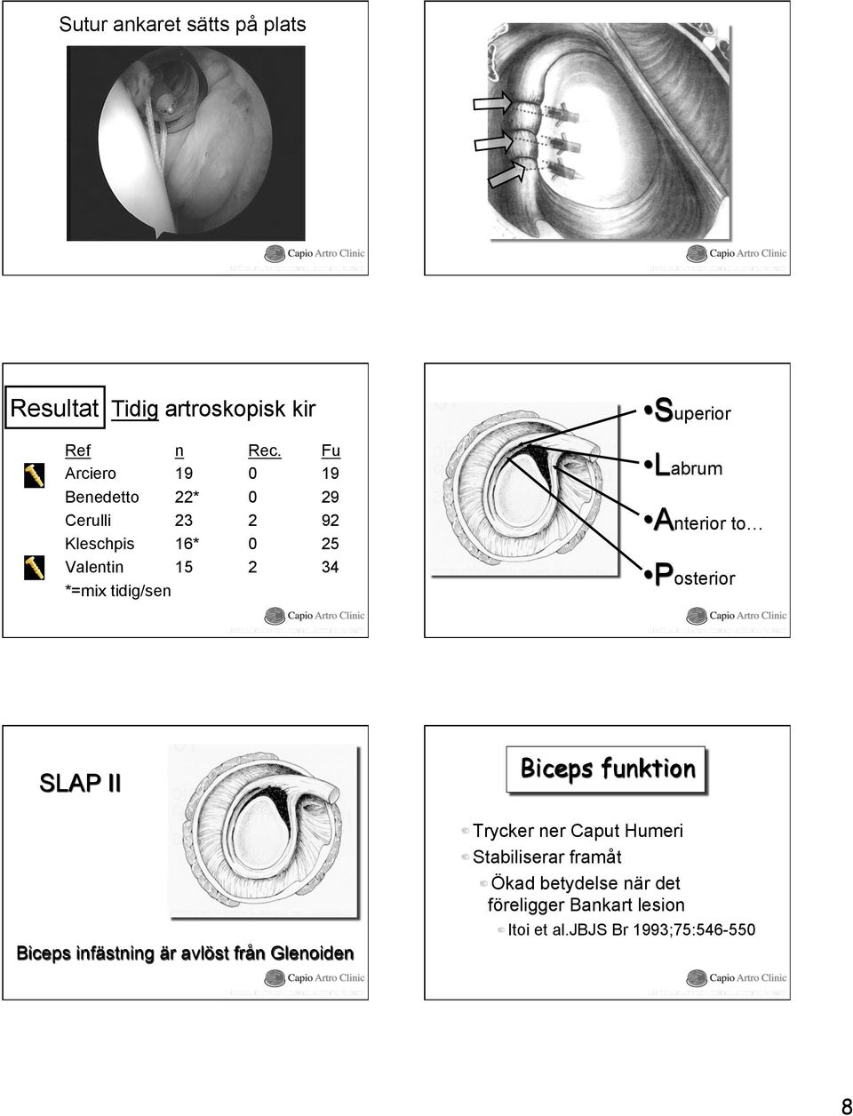 tidig/sen Superior Labrum Anterior to Posterior SLAP II Biceps infästning är avlöst från Glenoiden