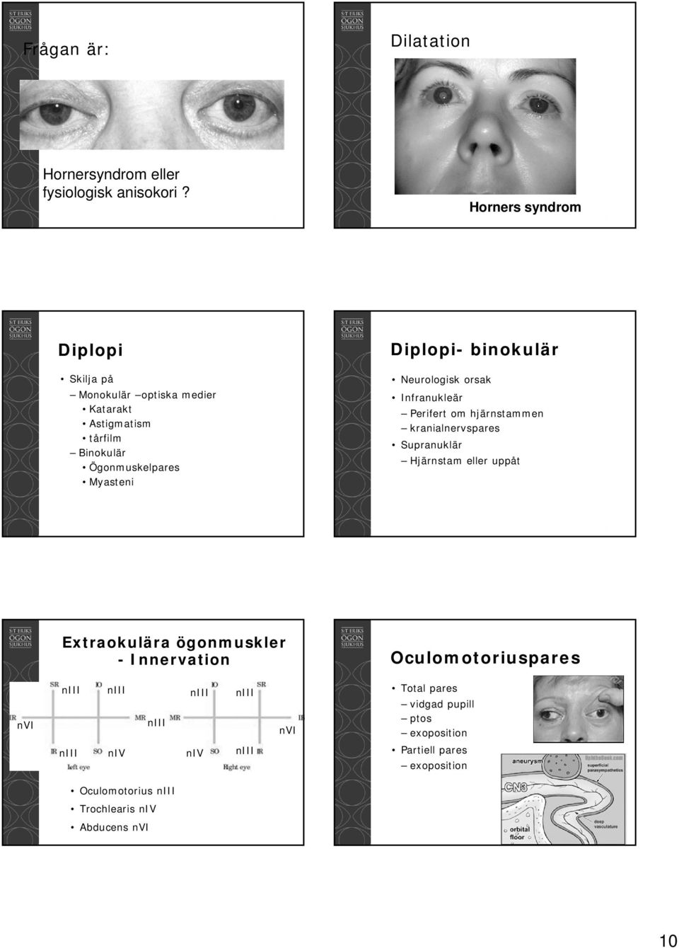 binokulär Neurologisk orsak Infranukleär Perifert om hjärnstammen kranialnervspares Supranuklär Hjärnstam eller uppåt Extraokulära