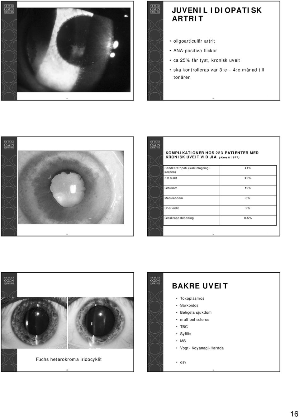(kalkinlagring i kornea) 41% Katarakt 42% Glaukom 19% Maculaödem 8% Chorioidit 2% Glaskroppsblödning 0.