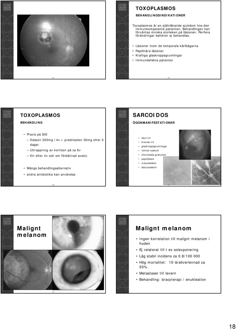 Läsioner inom de temporala kärlbågarna Papillnära läsioner Kraftiga glaskroppsgrumlingar Immundefekta patienter 103 104 TOXOPLASMOS BEHANDLING SARCOIDOS ÖGONMANIFESTATIONER Praxis på StE Dalacin