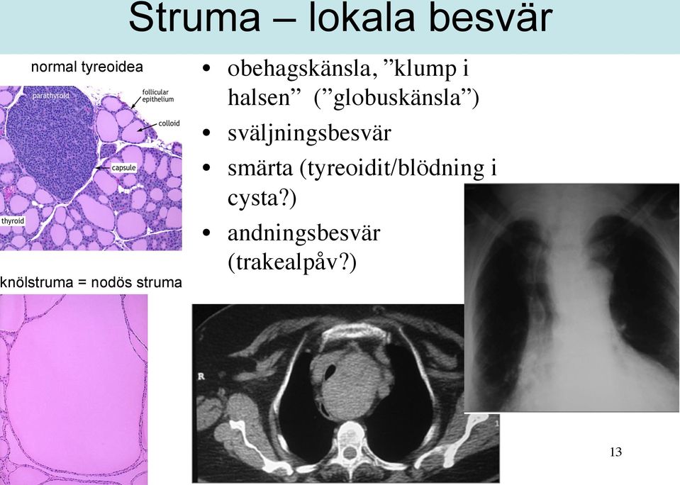 globuskänsla ) sväljningsbesvär smärta