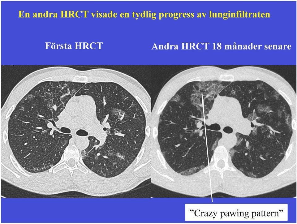 lunginfiltraten Första HRCT