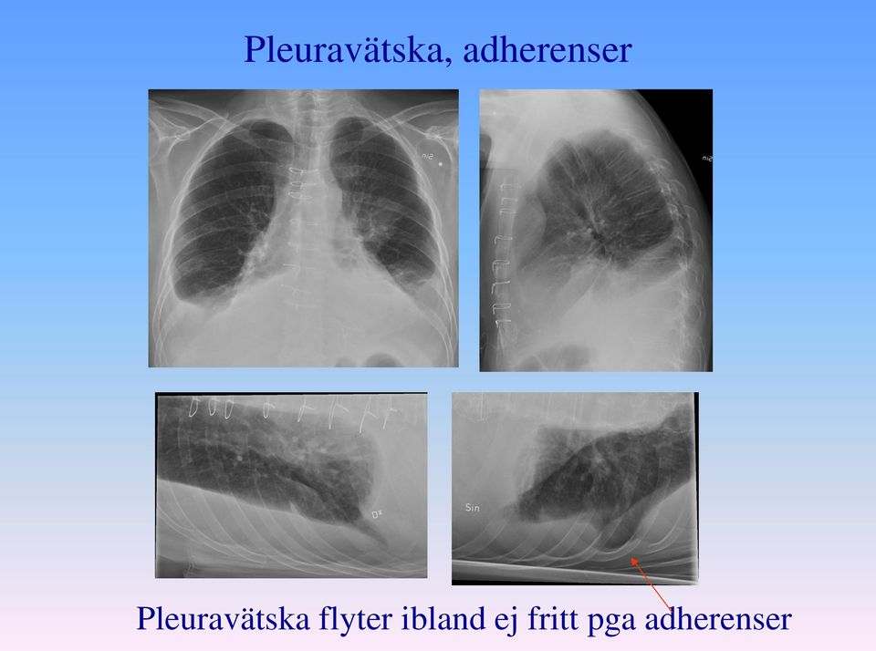 Pleuravätska