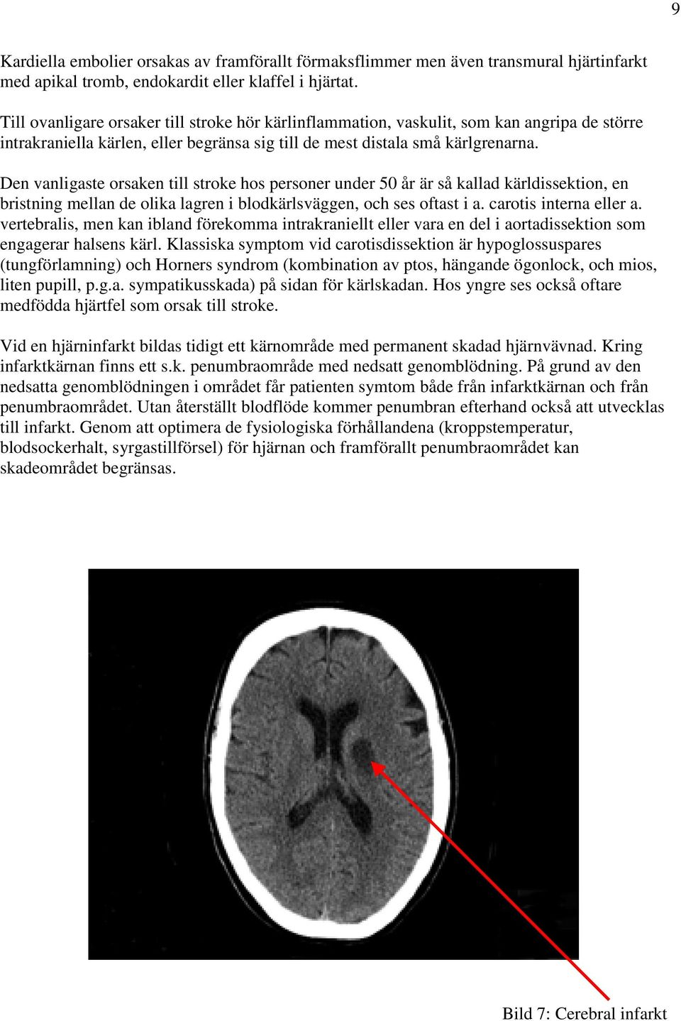 Den vanligaste orsaken till stroke hos personer under 50 år är så kallad kärldissektion, en bristning mellan de olika lagren i blodkärlsväggen, och ses oftast i a. carotis interna eller a.