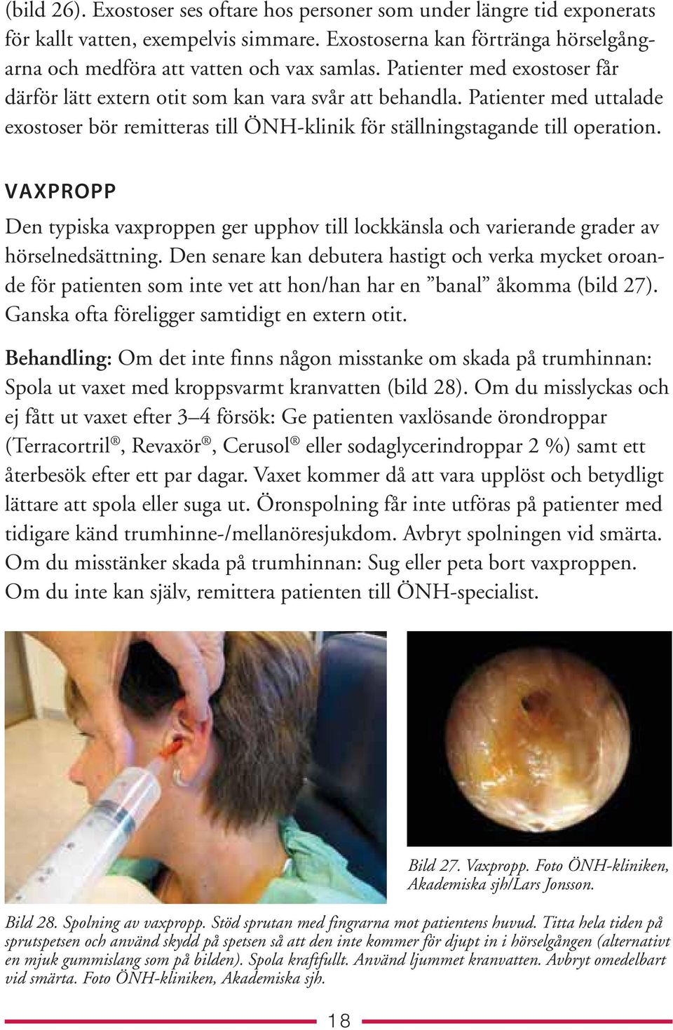VAXPROPP Den typiska vaxproppen ger upphov till lockkänsla och varierande grader av hörselnedsättning.