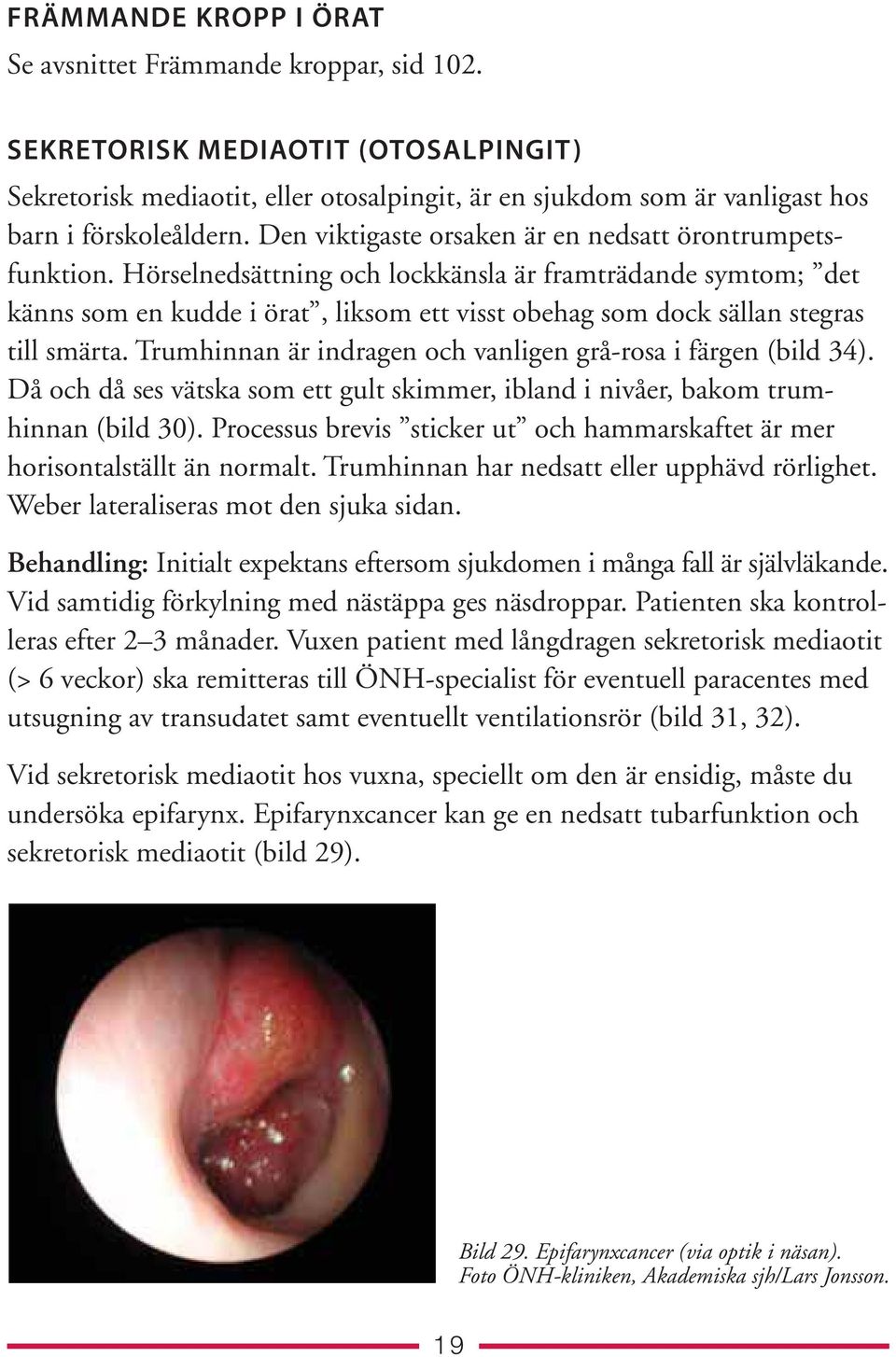 Hörselnedsättning och lockkänsla är framträdande symtom; det känns som en kudde i örat, liksom ett visst obehag som dock sällan stegras till smärta.