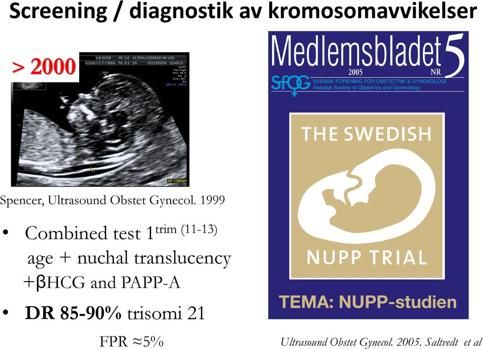 1999 Combined test 1trim (11-13) age + nuchal translucency