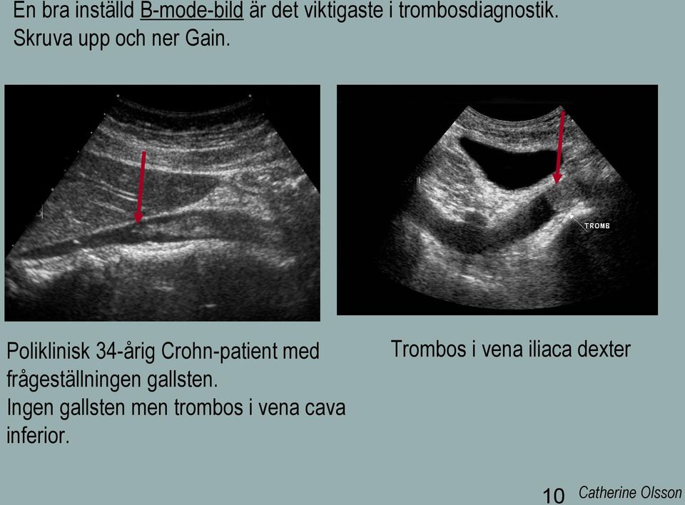 Poliklinisk 34-årig Crohn-patient med frågeställningen