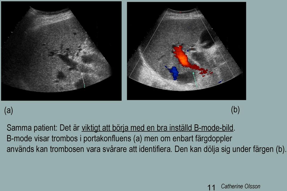 B-mode visar trombos i portakonfluens (a) men om enbart