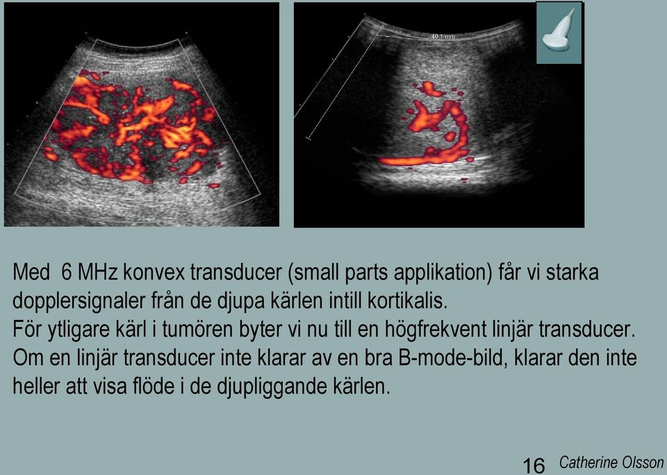 För ytligare kärl i tumören byter vi nu till en högfrekvent linjär transducer.