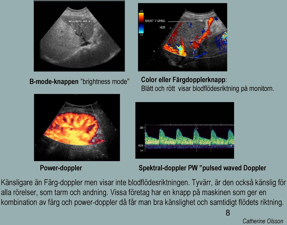 Spektral-doppler PW pulsed waved Doppler Känsligare än Färg-doppler men visar inte blodflödesriktningen.