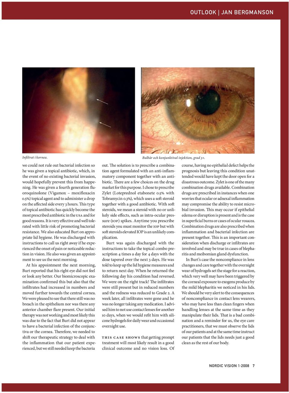 He was given a fourth generation fluoroquinolone (Vigamox moxifloxacin 0.5%) topical agent and to administer a drop on the affected side every 3 hours.