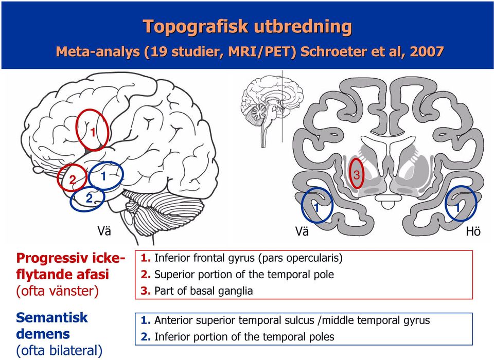 Inferior frontal gyrus (pars opercularis) 2. Superior portion of the temporal pole 3.