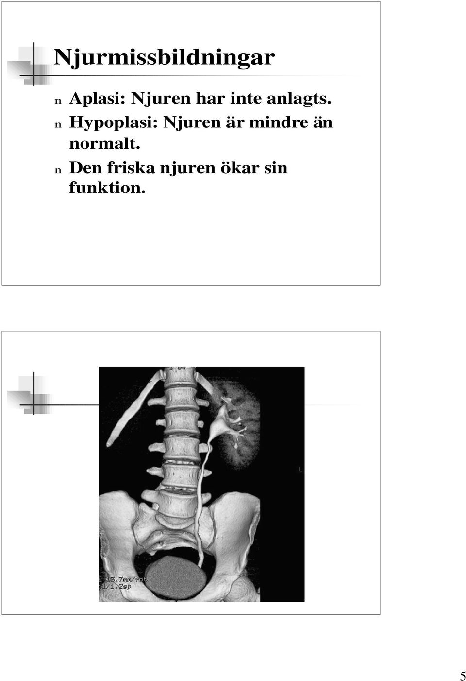 n Hypoplasi: Njuren är mindre än