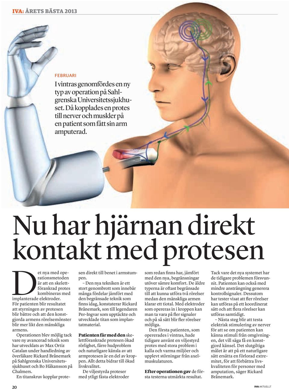 Nu har hjärnan direkt kontakt med protesen Det nya med operationsmetoden är att en skelettförankrad protes kombineras med implanterade elektroder.