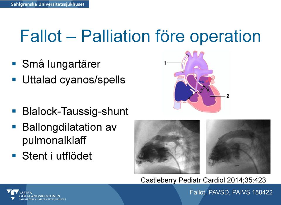 Blalock-Taussig-shunt Ballongdilatation av