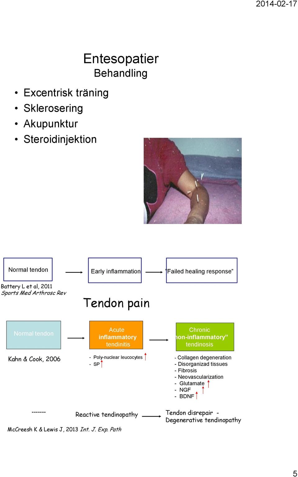 Poly-nuclear leucocytes - SP Chronic non-inflammatory tendinosis - Collagen degeneration - Disorganizad tissues - Fibrosis -