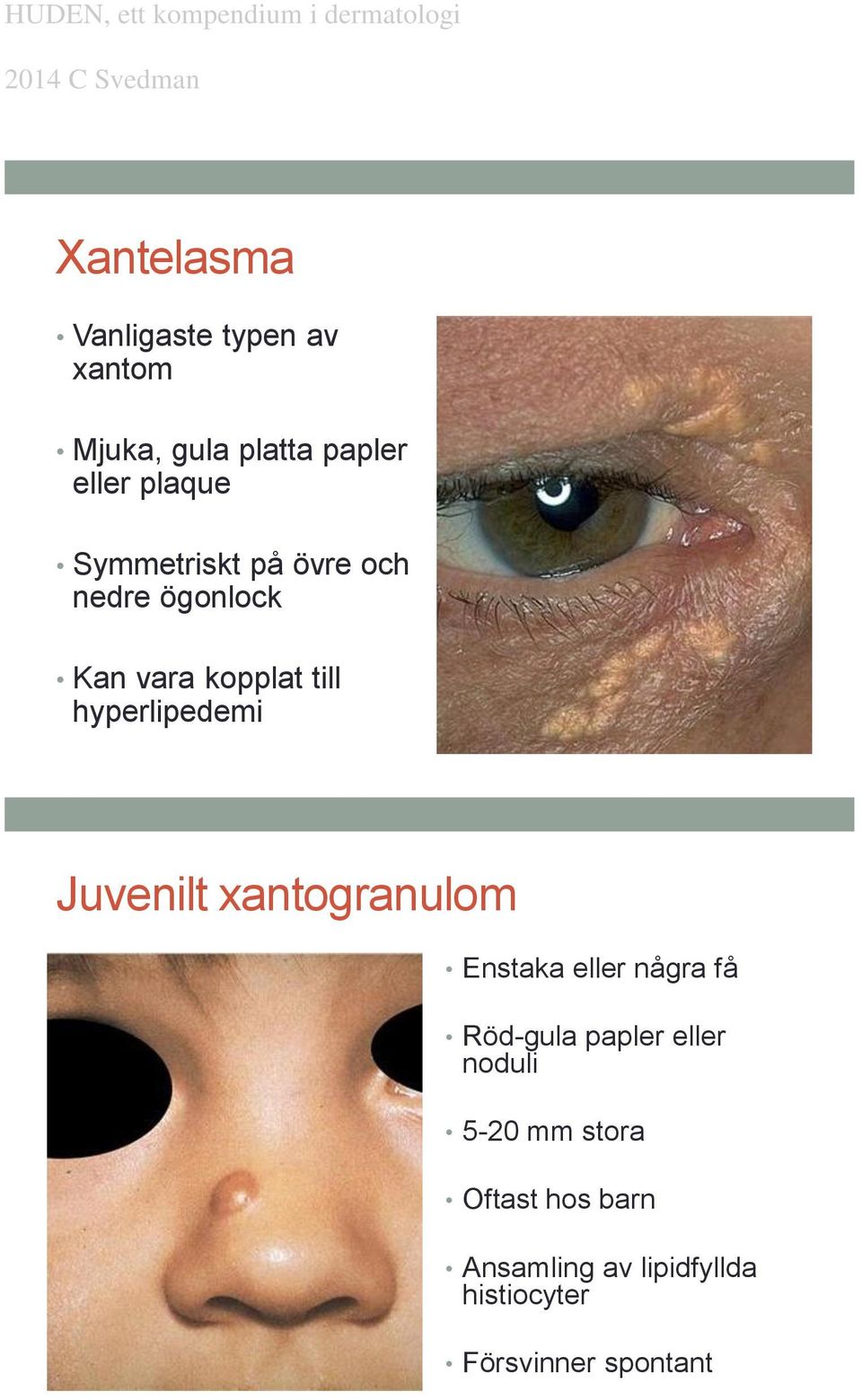 Juvenilt xantogranulom Enstaka eller några få Röd-gula papler eller noduli