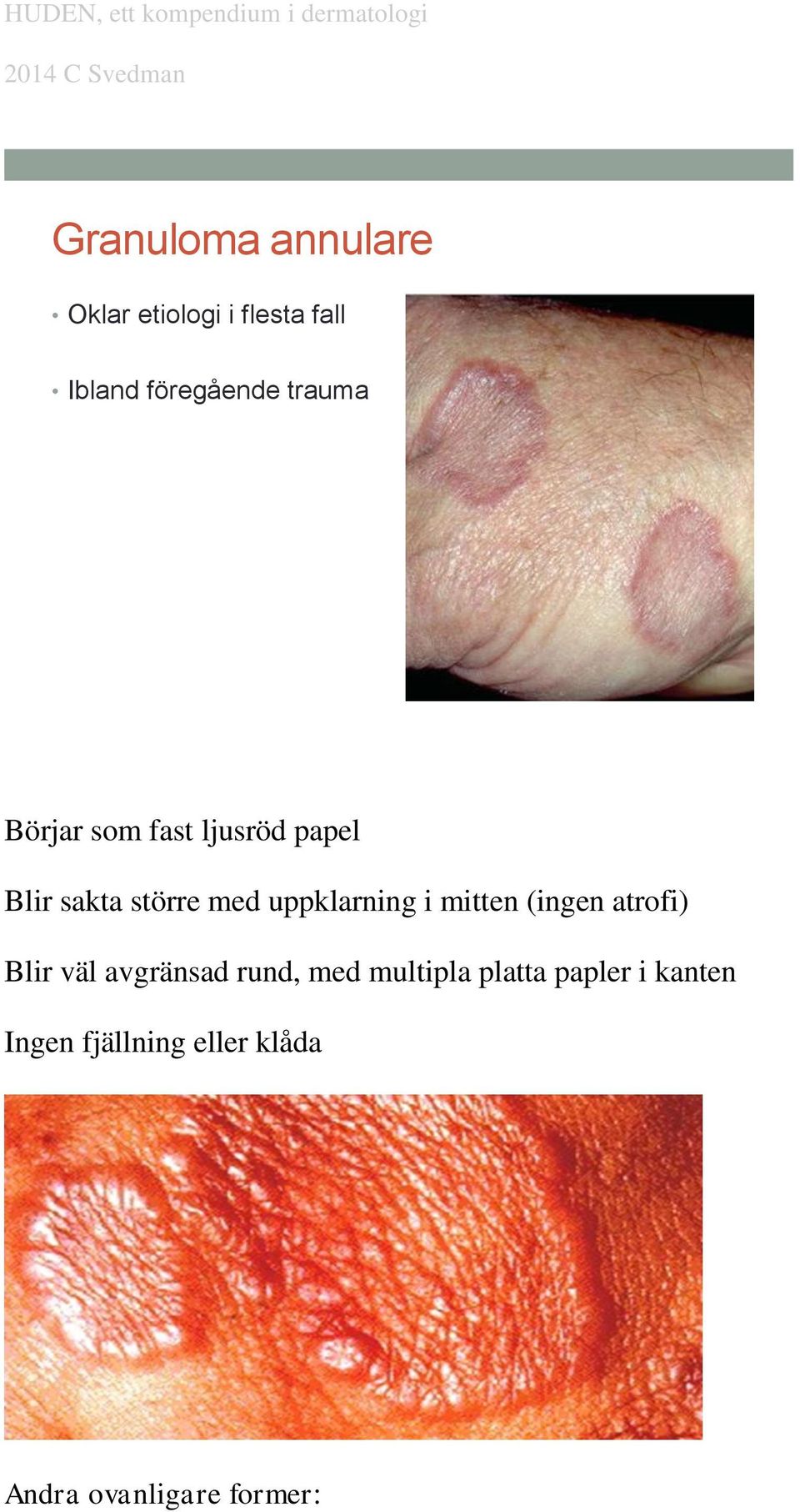 uppklarning i mitten (ingen atrofi) Blir väl avgränsad rund, med