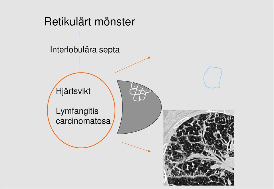 septa Hjärtsvikt