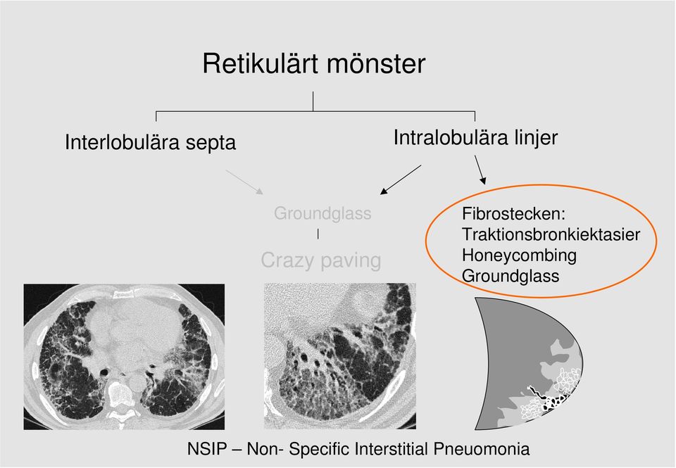 paving Fibrostecken: Traktionsbronkiektasier