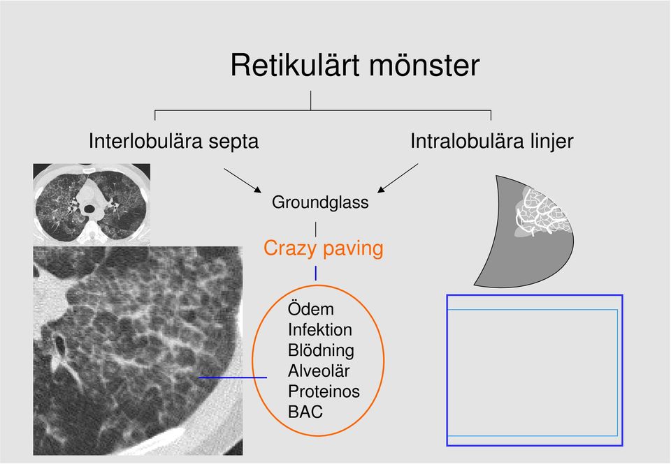 Intralobulära linjer